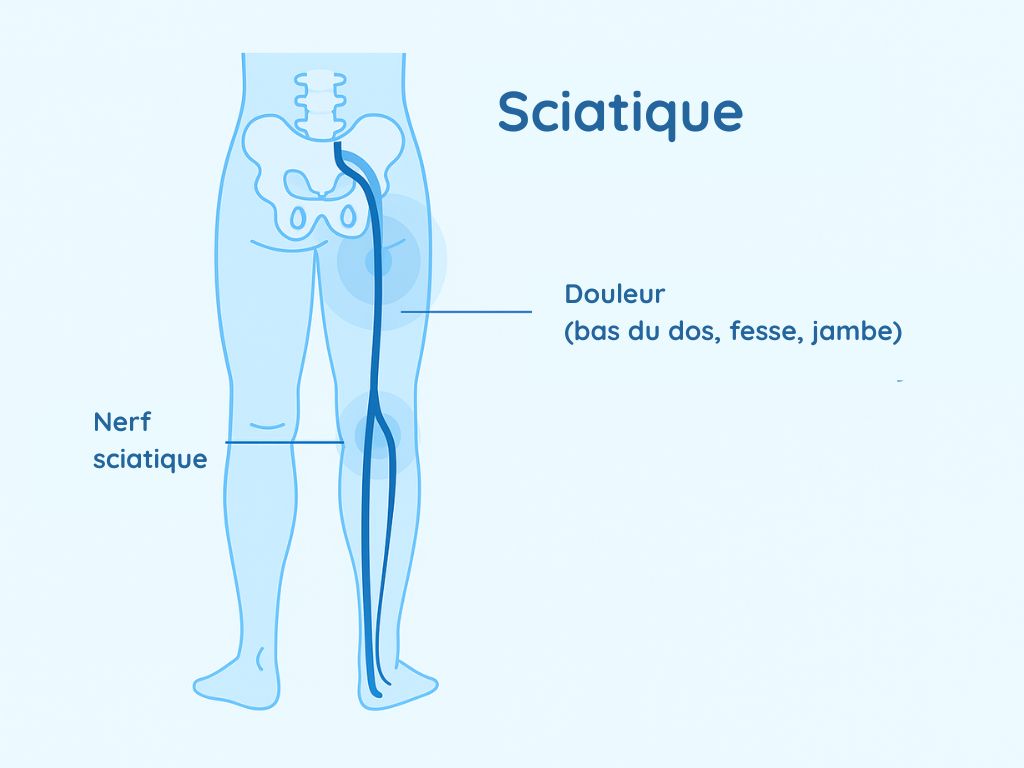 Schéma d'une douleur au nerf sciatique